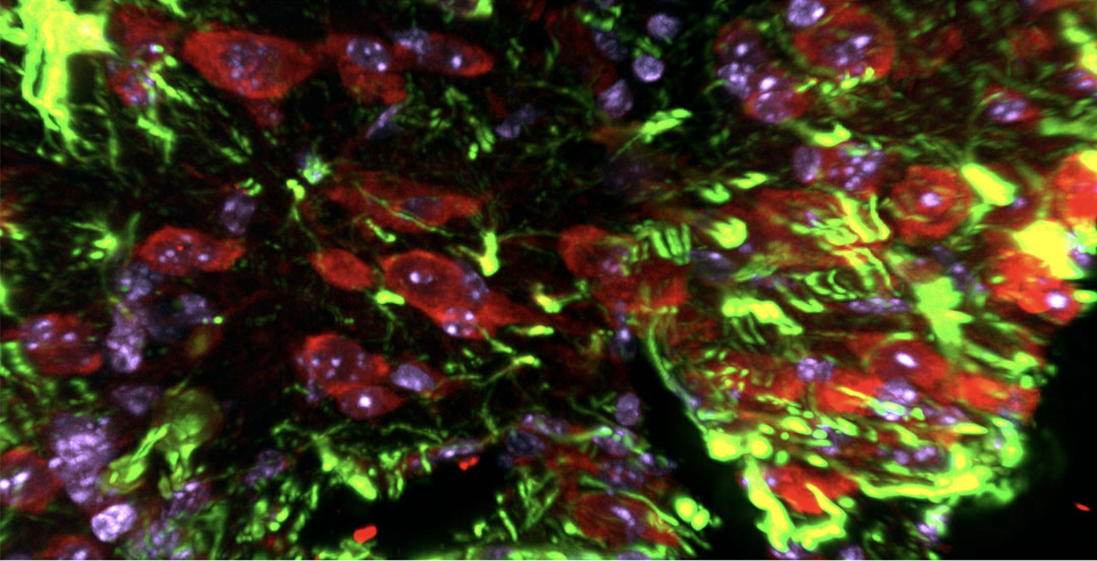 In vivo overexpression of Snail (Red) in microglia/macrophage cells in injured cortex. Reactive astrocytes are labeled in green bordering the injury.