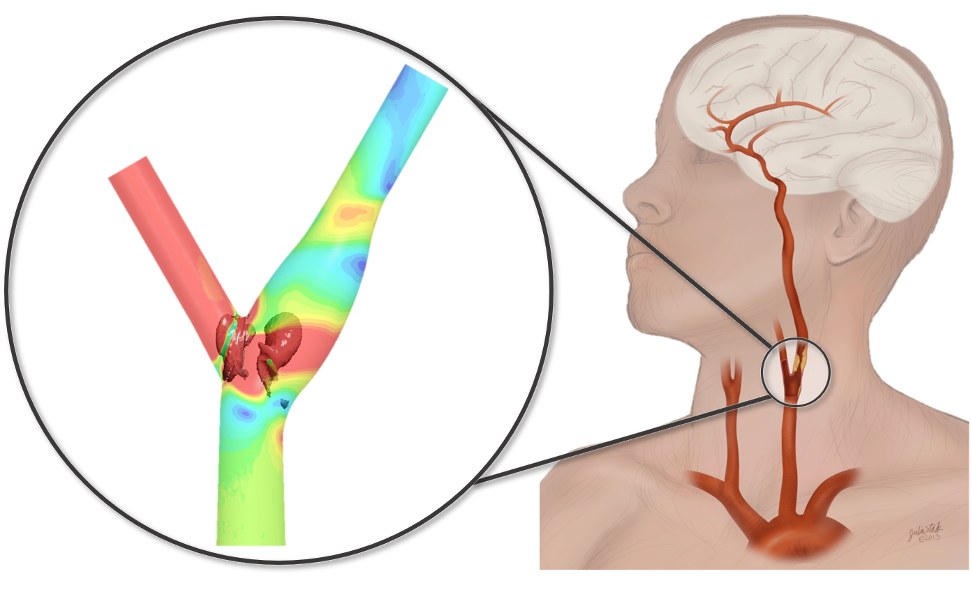 A view of the carotid artery bifurcation with Wild's results (circled) showing the pressure gradient of wall shear stress, with a vertical structure overlaid in darker gray. (Courtesy Caroline Wild)