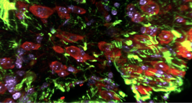 In vivo overexpression of Snail (Red) in microglia/macrophage cells in injured cortex. Reactive astrocytes are labeled in green bordering the injury.